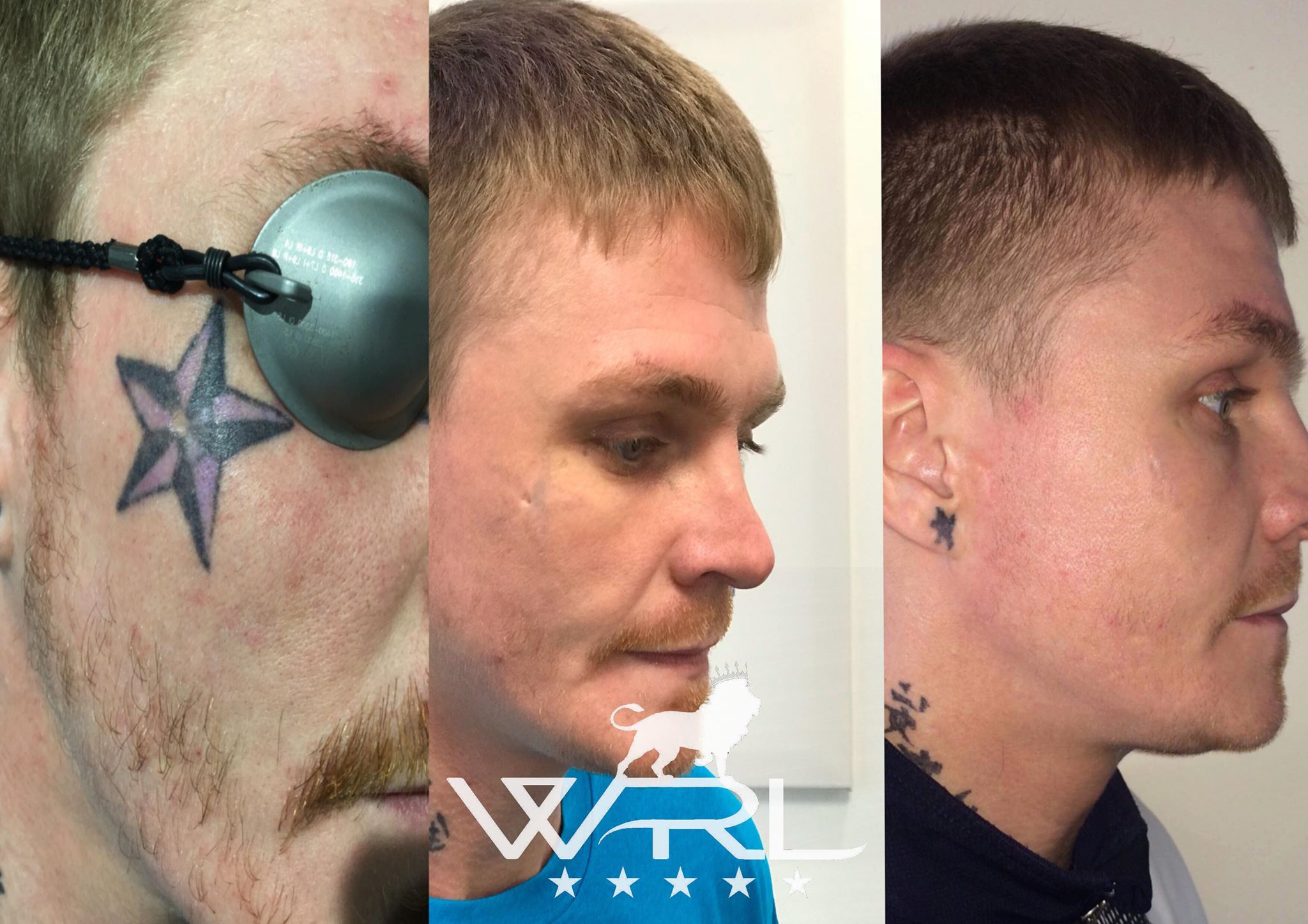 Laser Tattoo Removal Before and After in Plymouth Whiteroom Laser Ltd