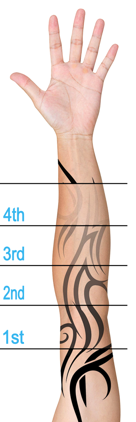 Cheap Laser Tattoo Removal in Plymouth Devon