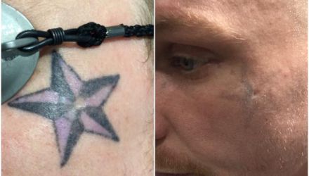 Laser Tattoo Removal Before and After in Plymouth