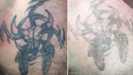 Laser Tattoo Removal Before and After in Plymouth, Devon