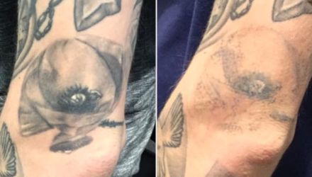 Laser Tattoo Removal Before and After in Plymouth, South Devon