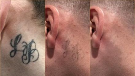 Watch This Man Have His Face Tattoo Removed From Laser Surgery  Business  Insider  YouTube