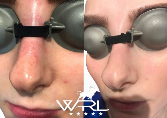 Laser Vascular Removal, Facial