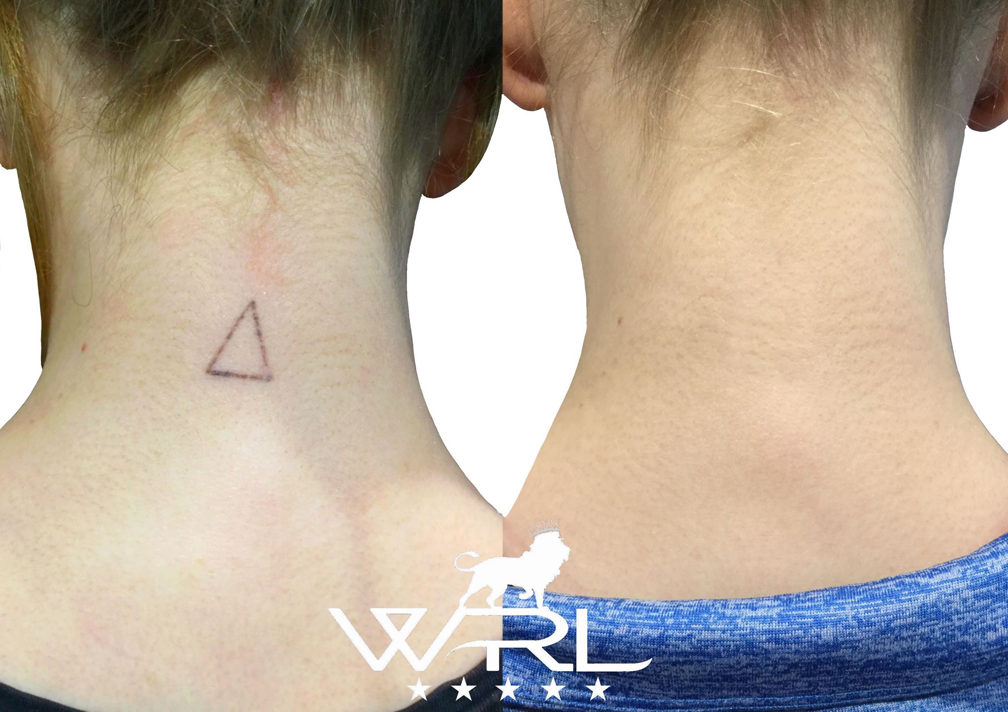 Laser Tattoo Removal in Plymouth, Devon - Whiteroom Laser Ltd Laser Tattoo Removal in Plymouth, Devon - Whiteroom Laser Ltd