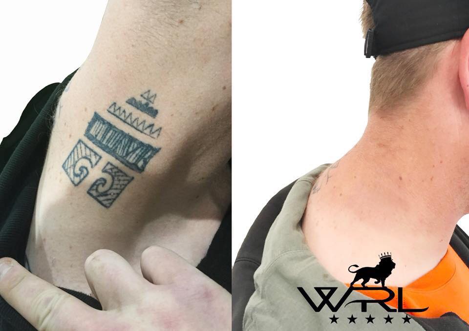 Neck Tatto Laser Removal in Plymouth