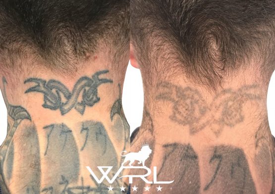 Laser Tattoo Removal