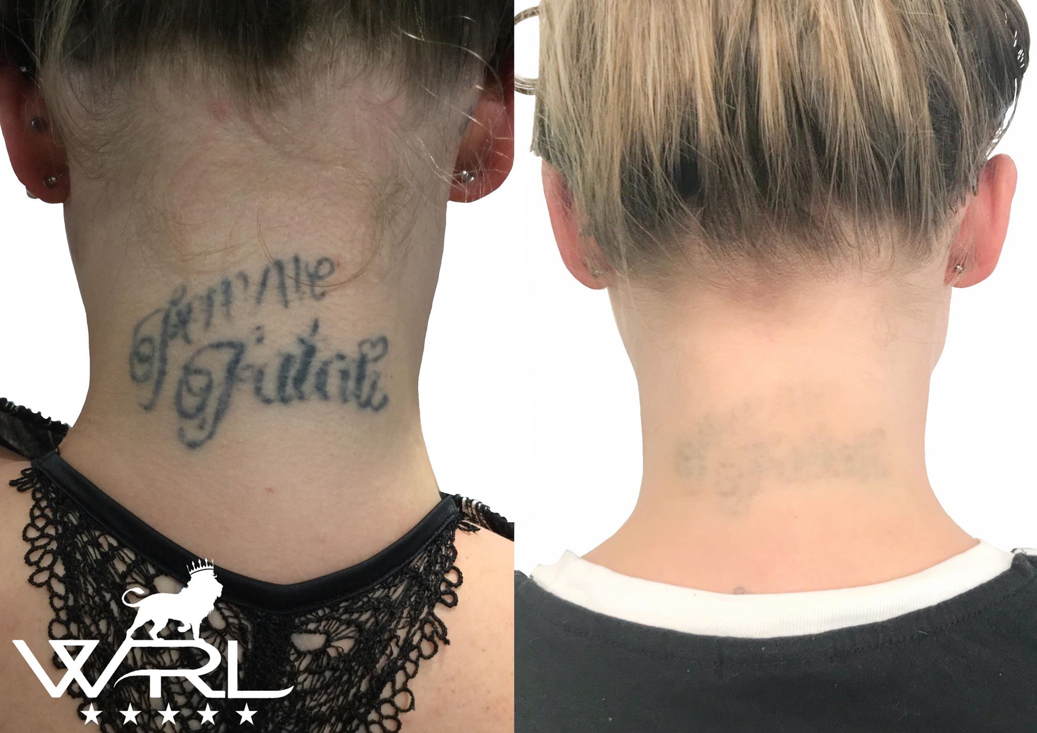 Laser Tattoo Removal Plymouth