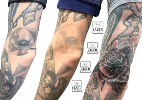 Laser Tattoo Removal