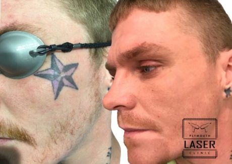 Laser Tattoo Removal