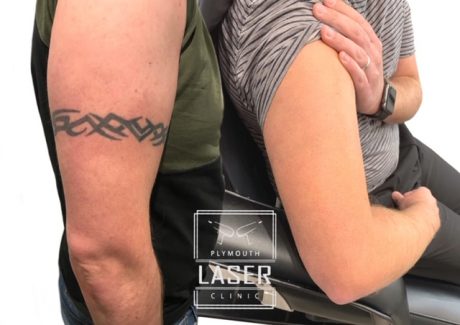 Laser Tattoo Removal