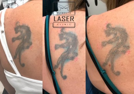 Laser Tattoo Removal