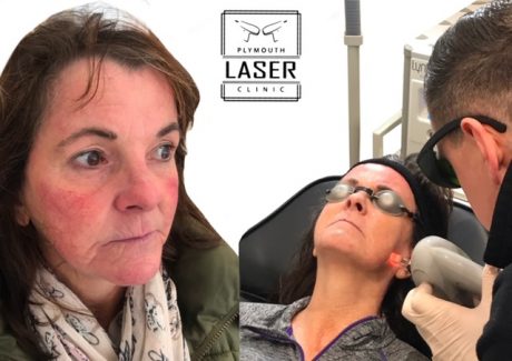 Laser Pigmentation Removal