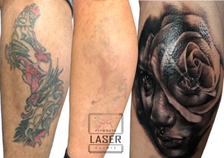 Laser Tattoo Removal