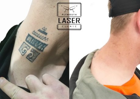 Laser Tattoo Removal