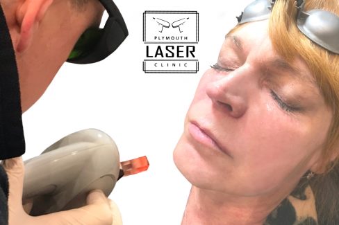 Laser Pigmentation Removal