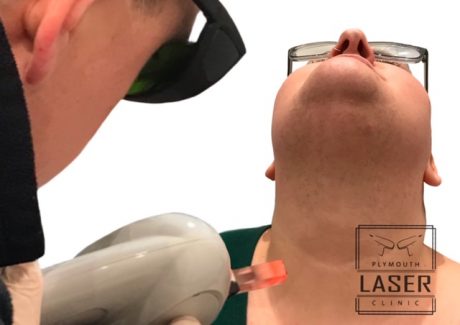 Laser Tattoo Removal