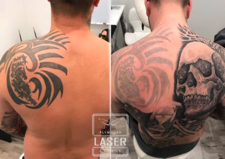 Laser Tattoo Removal