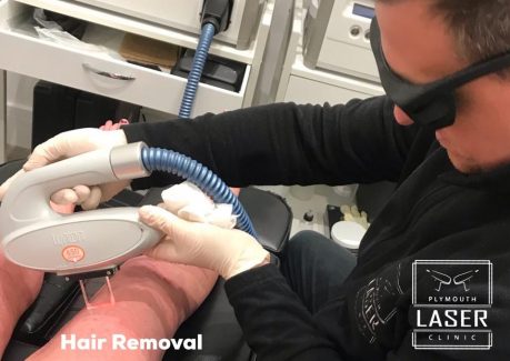 Laser Pigmentation Removal