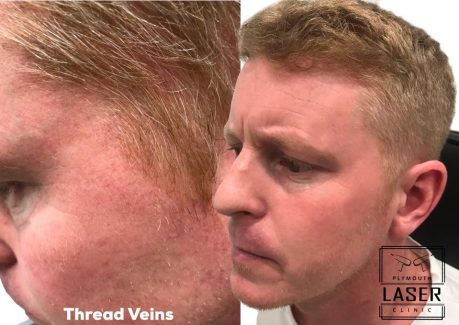 Laser Pigmentation Removal