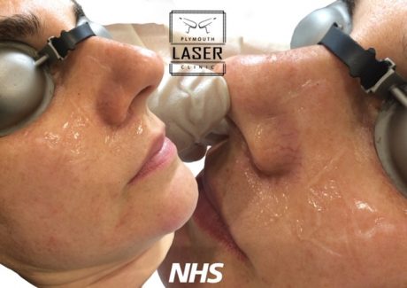 Laser Pigmentation Removal