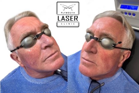 Laser Pigmentation Removal