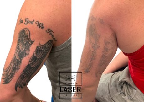 Laser Tattoo Removal