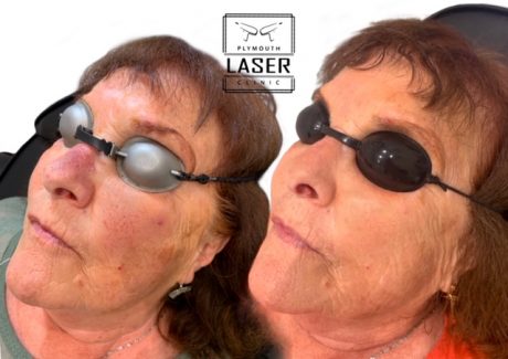 Laser Pigmentation Removal