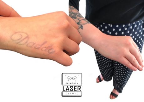 Laser Tattoo Removal