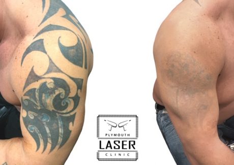 Laser Tattoo Removal
