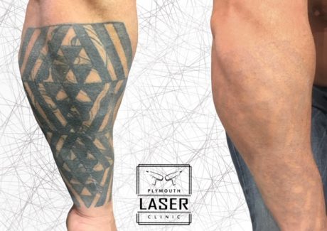 Laser Tattoo Removal