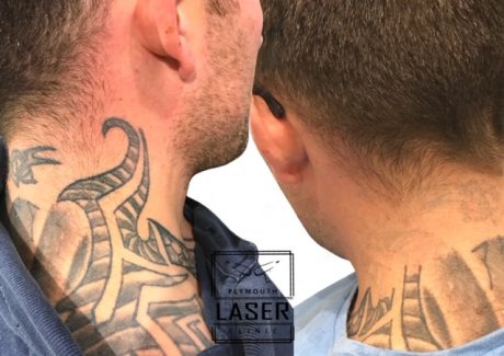 Laser Tattoo Removal