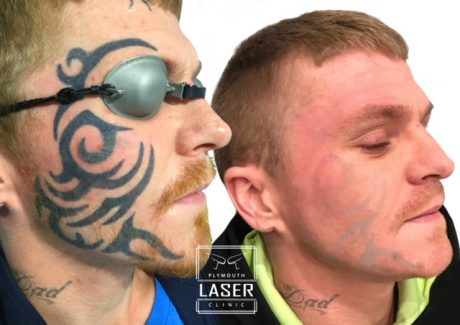 Laser Tattoo Removal