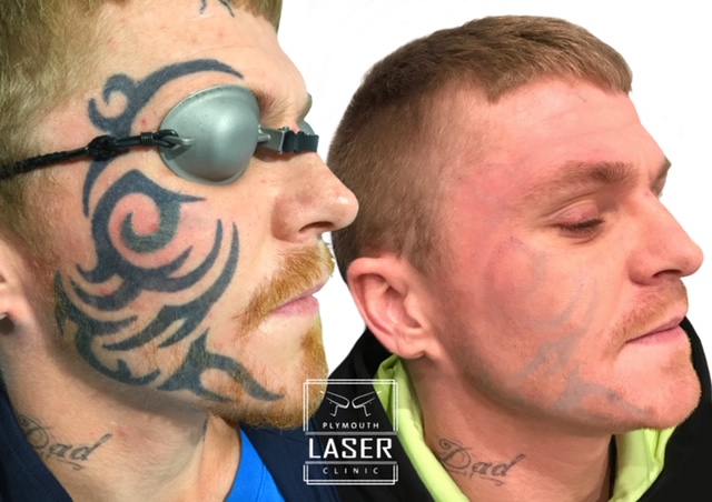 Laser Tattoo Removal Whiteroom Laser Ltd